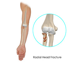 Picture of Radial Head Dislocation