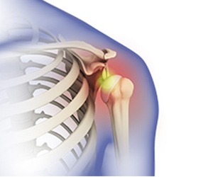 Picture of Shoulder Dislocation