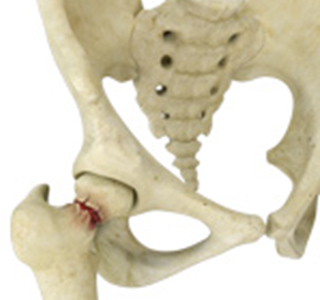 Picture of Stress Fractures