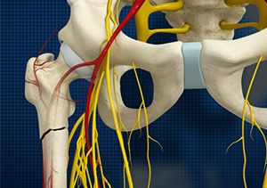 Picture of Subtrochanteric Hip Fracture