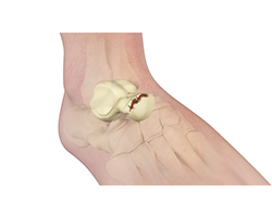 Picture of Talus Fracture