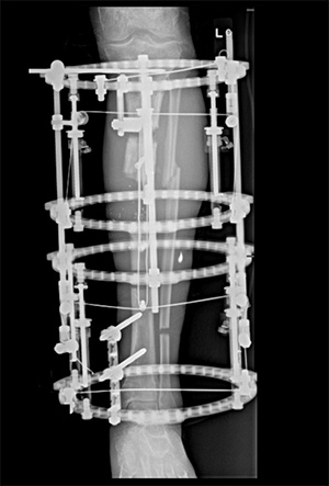 Picture of Balanced Cable Transport