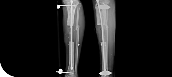 Picture of Bone Defect