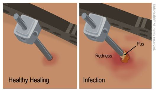 Signs of a Pin Infection