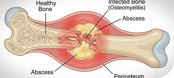 Picture of Osteomyelitis