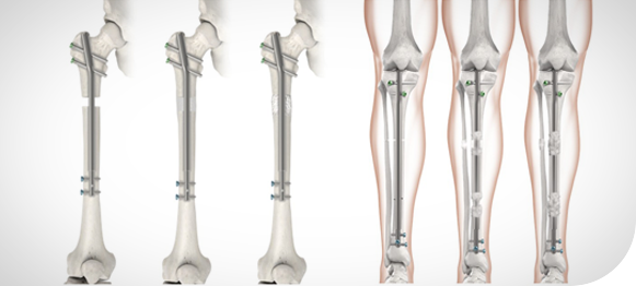 Picture of Stature Lengthening