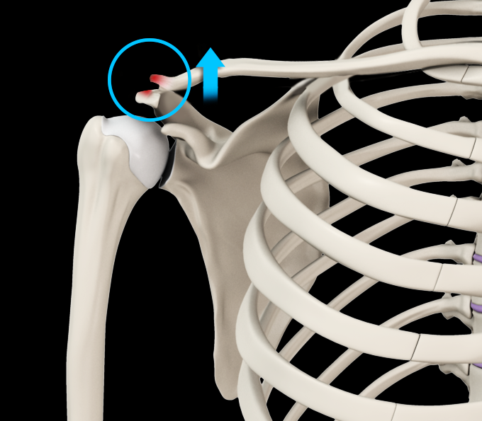 Acromioclavicular Joint Dislocation (Shoulder Separation) Images