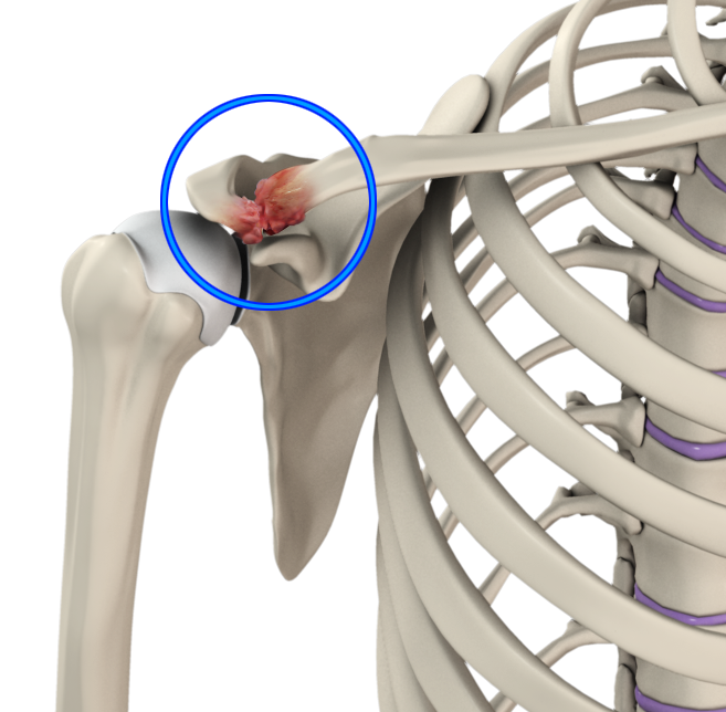 Acromioclavicular (AC) Joint Osteoarthritis Images