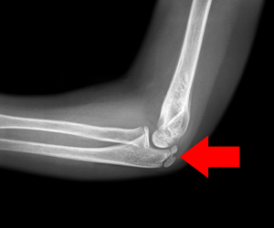 Adolescent Elbow Injuries Images