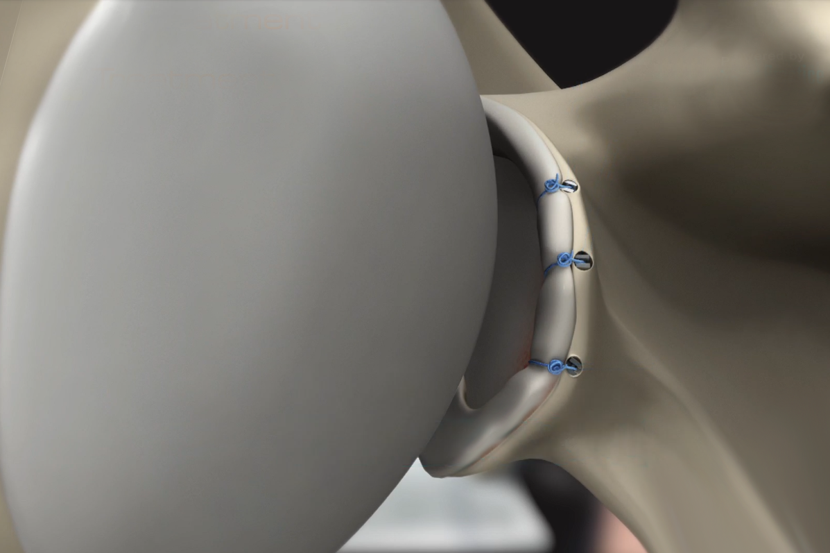 Anterior Shoulder Stabilization Images