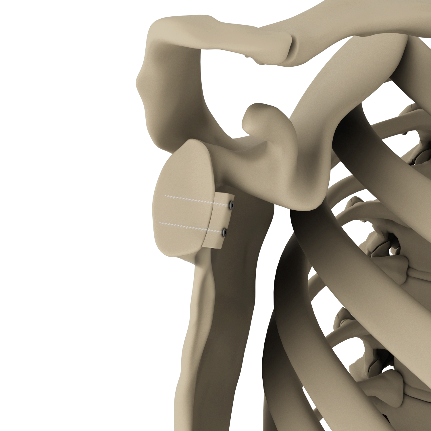 Arthroscopic Glenoid Bone Grafting Images