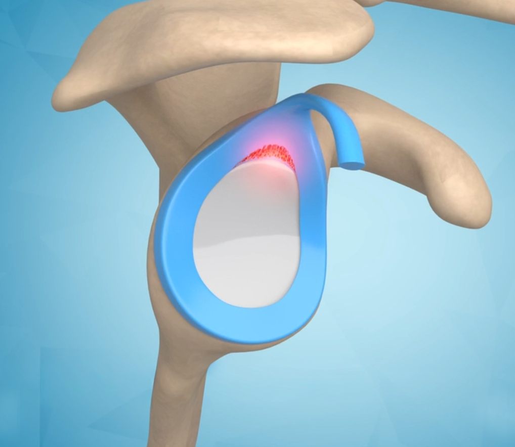 Baseball and Shoulder Injuries Images