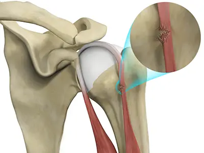 Bicep Tendon Rupture at Shoulder Images