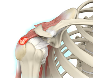 Calcific Tendonitis Images