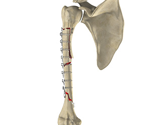 Complex Fracture Repair of the Shoulder Images