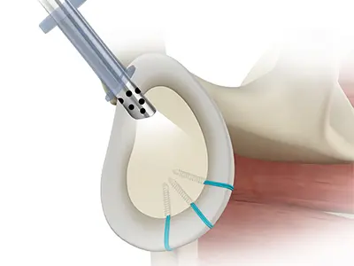 Complex Shoulder Reconstruction Images