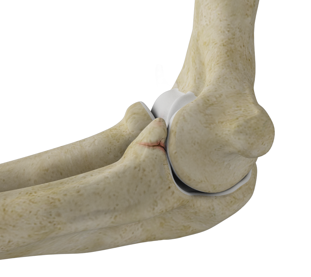 Coronoid Fracture of the Elbow Images