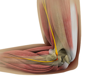 Cubital Tunnel Release (Medial Epicondylectomy) Images
