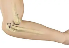 Elbow dislocation Images
