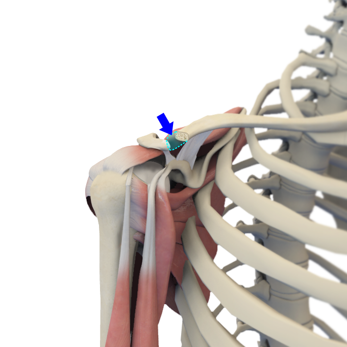 Distal Clavicle Excision Images