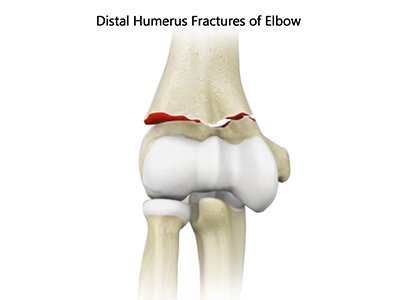 Distal Humerus Fractures of the Elbow Images