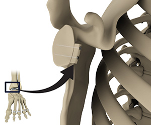 Distal Tibial Allograft Glenoid Reconstruction Images