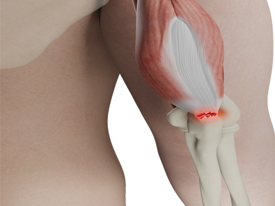 Distal Triceps Tear Images