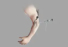 Elbow Arthroscopy Images