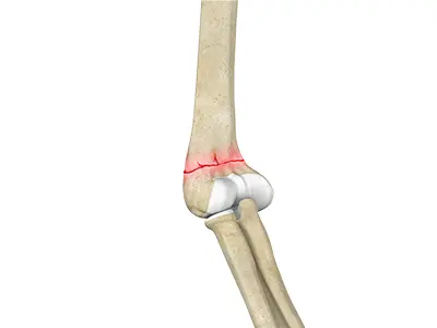 Elbow (Olecranon) Fractures Images