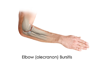 Elbow Osteoarthritis Images