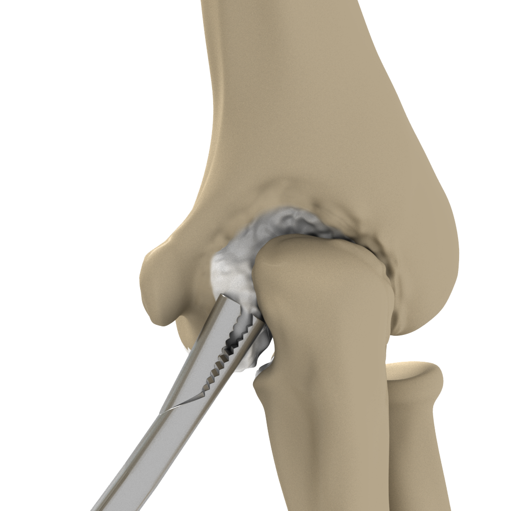 Elbow Stiffness Surgery Images