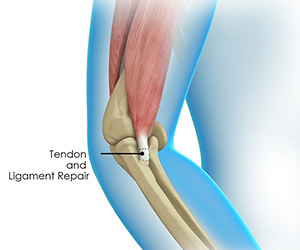 Elbow Tendon and Ligament Repair Images