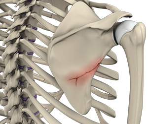 Fracture of the Shoulder Blade (Scapula) Images