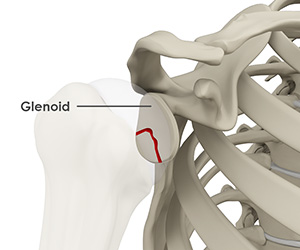 Glenoid Fractures Images