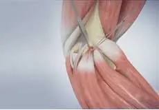 Golfer’s Elbow Surgery Images