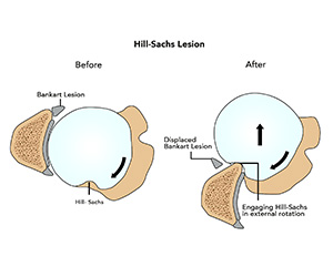 Hill-Sachs Lesion Images