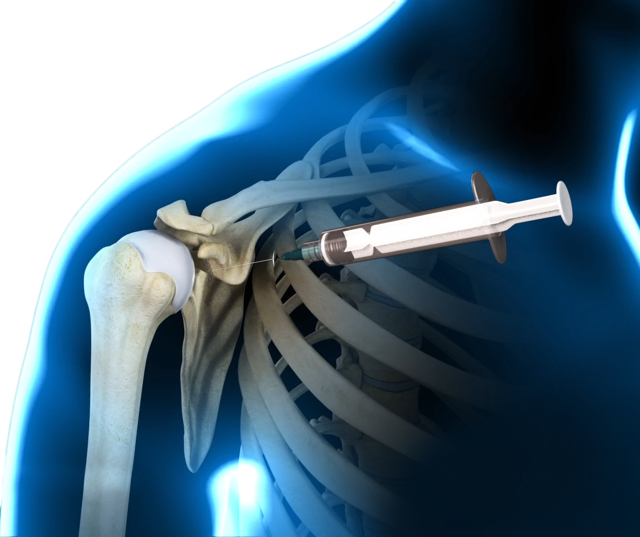 Hyaluronic Acid Injections Images