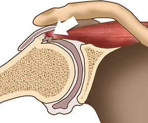 Internal Impingement of the Shoulder Images