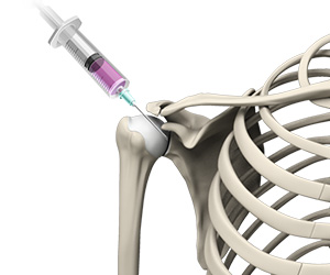 Intraarticular Shoulder Injection Images