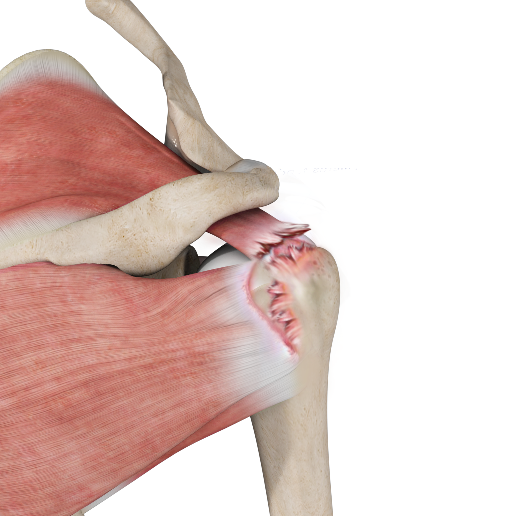 Irreparable Rotator Cuff Tears Images