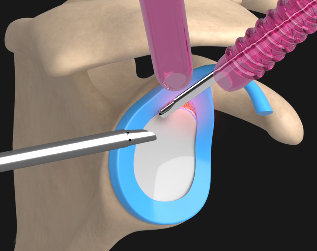 Labral Debridement and Repair Images