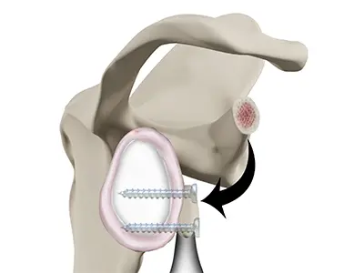 Latarjet Procedure Images