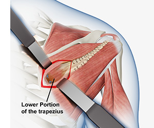 Lower Trapezius Tendon Transfer Images