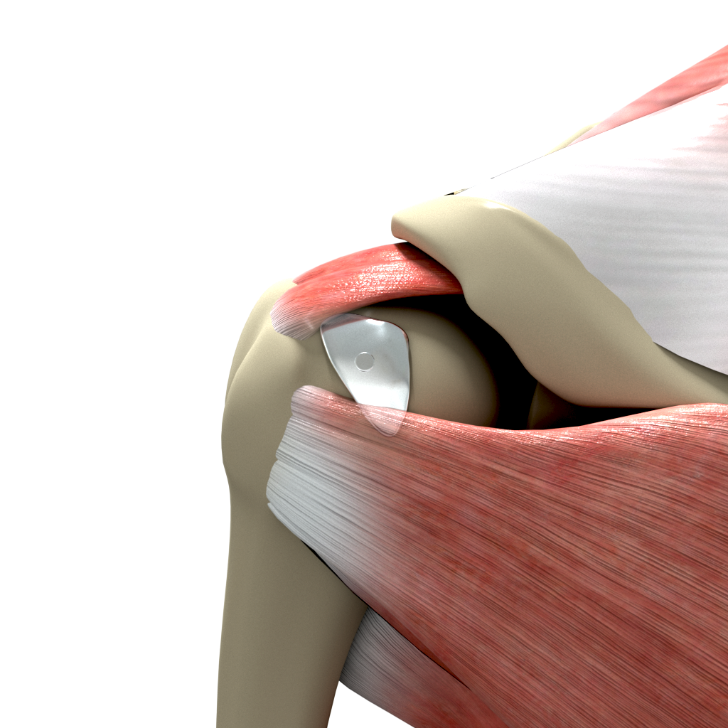 Metallic replacement of Hill Sachs lesion Images