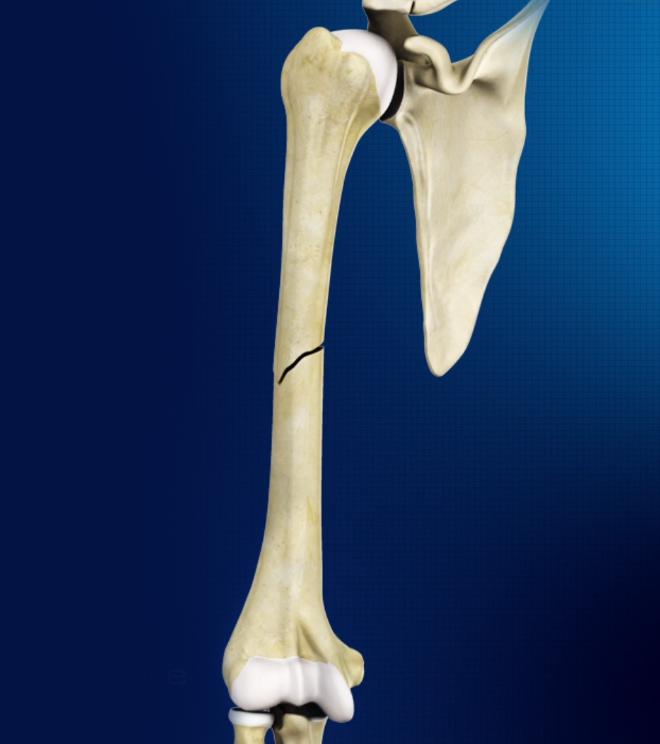 Mid-shaft Humerus Fracture Images