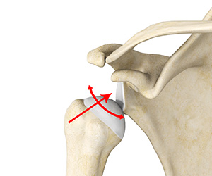 Multidirectional Instability of the Shoulder Images