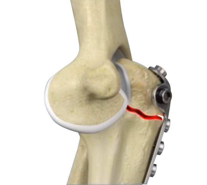 Nonunion Surgery (Elbow) Images