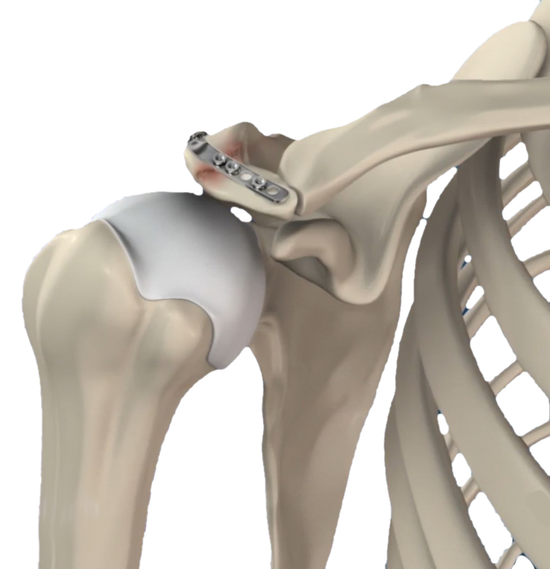 Nonunion Fixation of a Shoulder Fracture Images