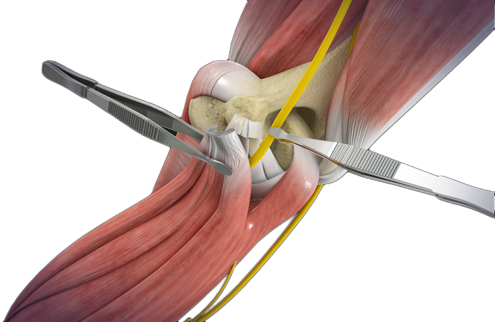 Open Cubital Tunnel Repair Images