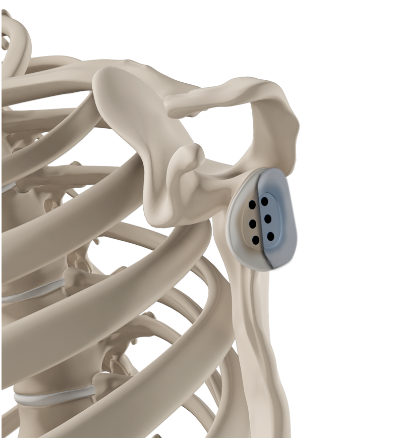 Open Glenoid Bone Grafting Images